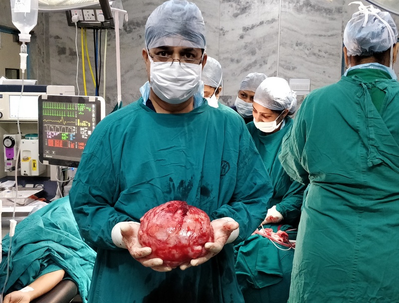 Huge fibroid removed from uterus of a 30 year old patient at Kasturba Hospital, Manipal