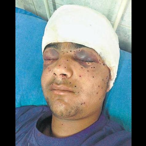 Police pellets blind Kashmir teen