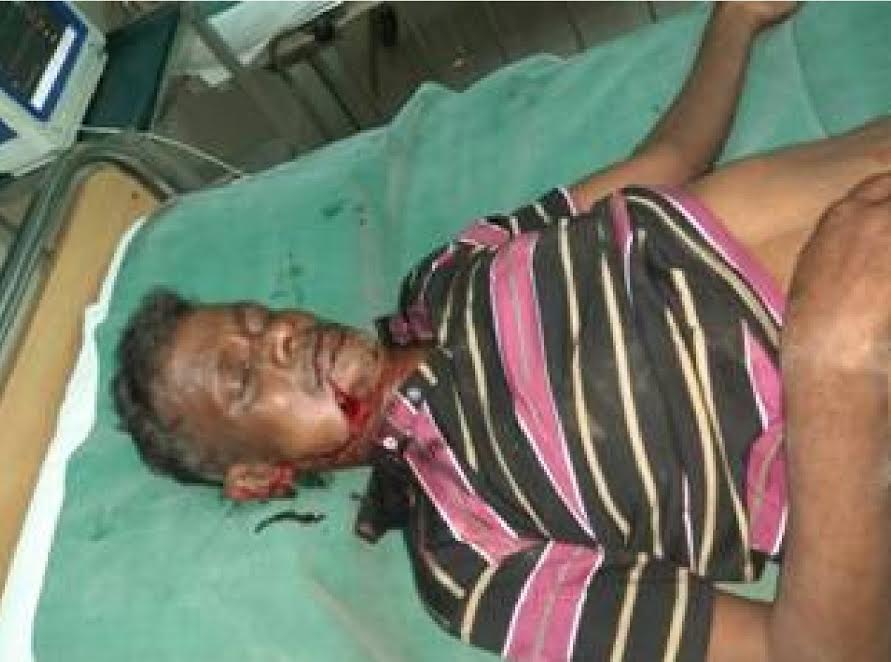 Hit and run, pedestrian seriously injured at Santhekatte, struggling at Wenlok Hospital