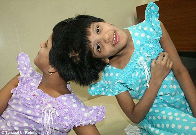 UK hospital to help surgically separate conjoined twins