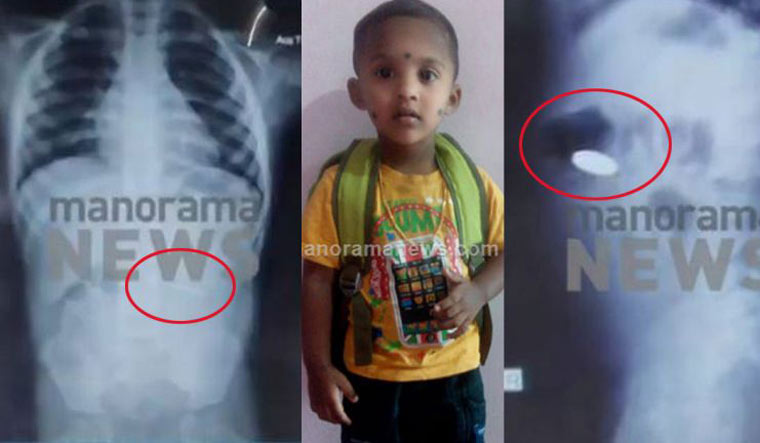 Kerala: Three-year-old boy dies after swallowing coin Kerala: Three-year-old boy dies after swallowing coin