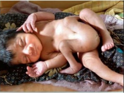 Baby with 4 legs and 2 male sex organs born in Raichur